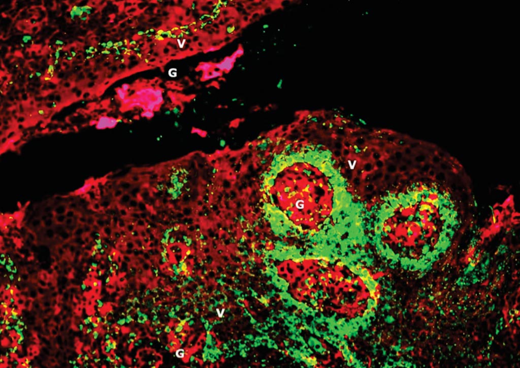 Image: Human papilloma virus (HPV) encased in biofilms inside tonsil crypts (pictured) may explain why the roughly 5% of HPV-infected people who develop cancer of the mouth or throat are not protected by their immune systems. Tonsil crypts with HPV are shown in green; epithelial and biofilm layers are shown in red (Photo courtesy of Dr. Katherine Rieth, MD).