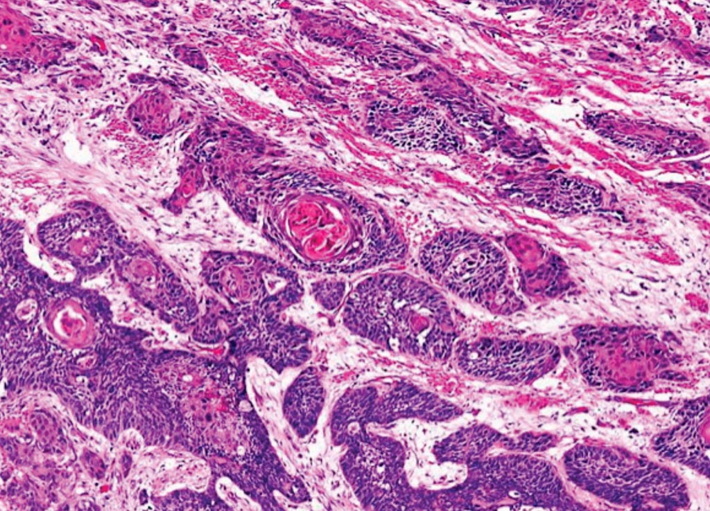 Image: A histopathology of esophageal squamous cell carcinoma with keratin pearl formation (Photo courtesy of Dr. Dharam Ramnani, MD).