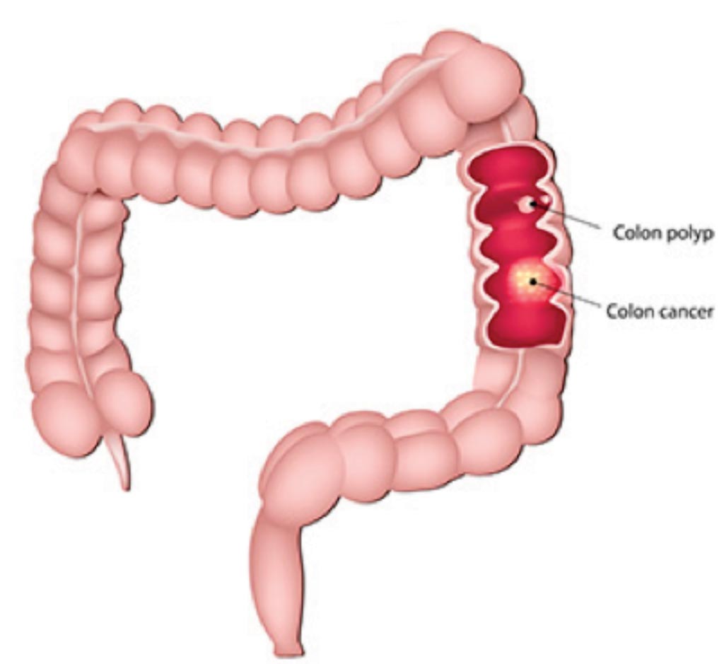 Image: A diagram of colon cancer and a colon polyp; not all polyps are cancerous, but nearly all colorectal cancers begin as a polyp (Photo courtesy of Jefferson Health).