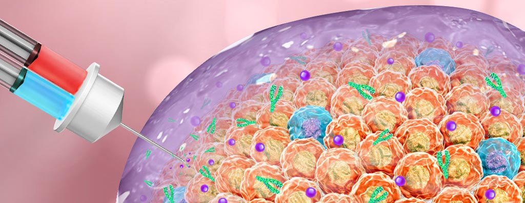 Image: When injected into tumors, this therapy forms a gel to attack cancer cells (Photo courtesy of the Gu Laboratory, University of North Carolina).