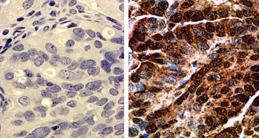 图片：子宫内膜样卵巢癌显示BRCA2的核染色（右半部）；子宫内膜样卵巢癌BRCA2阴性染色（左半部）（图片蒙德克萨斯大学MD安德森癌症中心惠赐）。