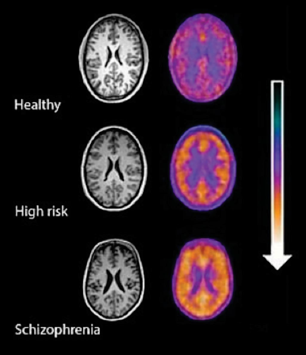 Image: Positron emission tomography (PET) imaging signal in healthy volunteers, high-risk subjects and patients with schizophrenia showing a stepwise elevation in microglial activity (orange) as severity of illness increases (Photo courtesy of MRC\'s Clinical Sciences Centre).