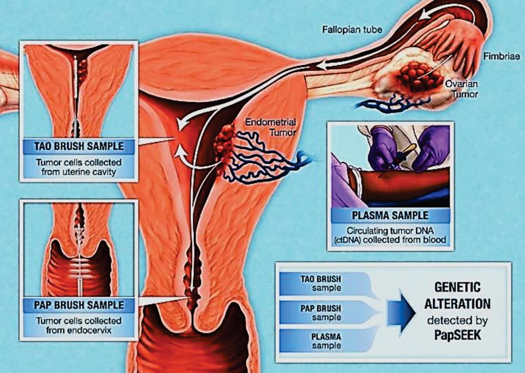 Image: Since fluid from the Pap test occasionally contains cells from the endometrium or ovaries, scientists found they could detect cancer cells from these organs that are present in the fluid by using different brushes (Photo courtesy of Johns Hopkins University).