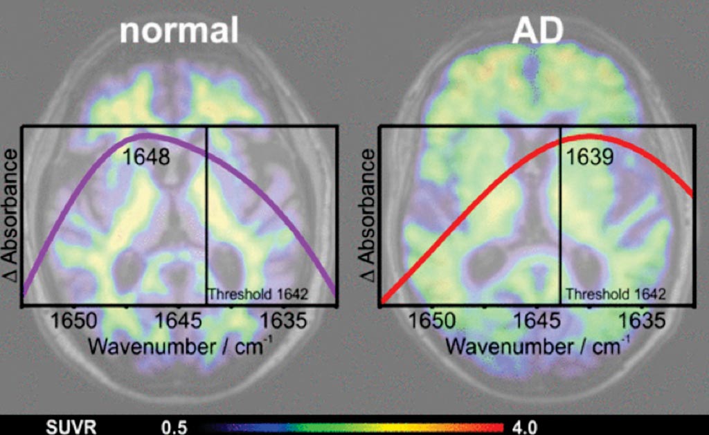 Image: Determination of the amyloid‐beta (Aβ) secondary structure distribution in blood plasma by an immuno‐IR‐sensor correlates with PET scanning and CSF markers in Alzheimer\'s disease (AD) patients, with potentials to be an accurate, simple, and minimally invasive biomarker for early AD detection (Photo courtesy of Ruhr University Bochum).