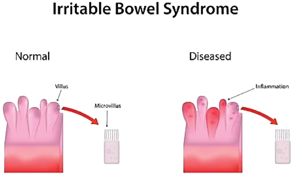 Image: A diagram comparing normal and diseased in irritable bowel syndrome (Photo courtesy of HealthNormal).