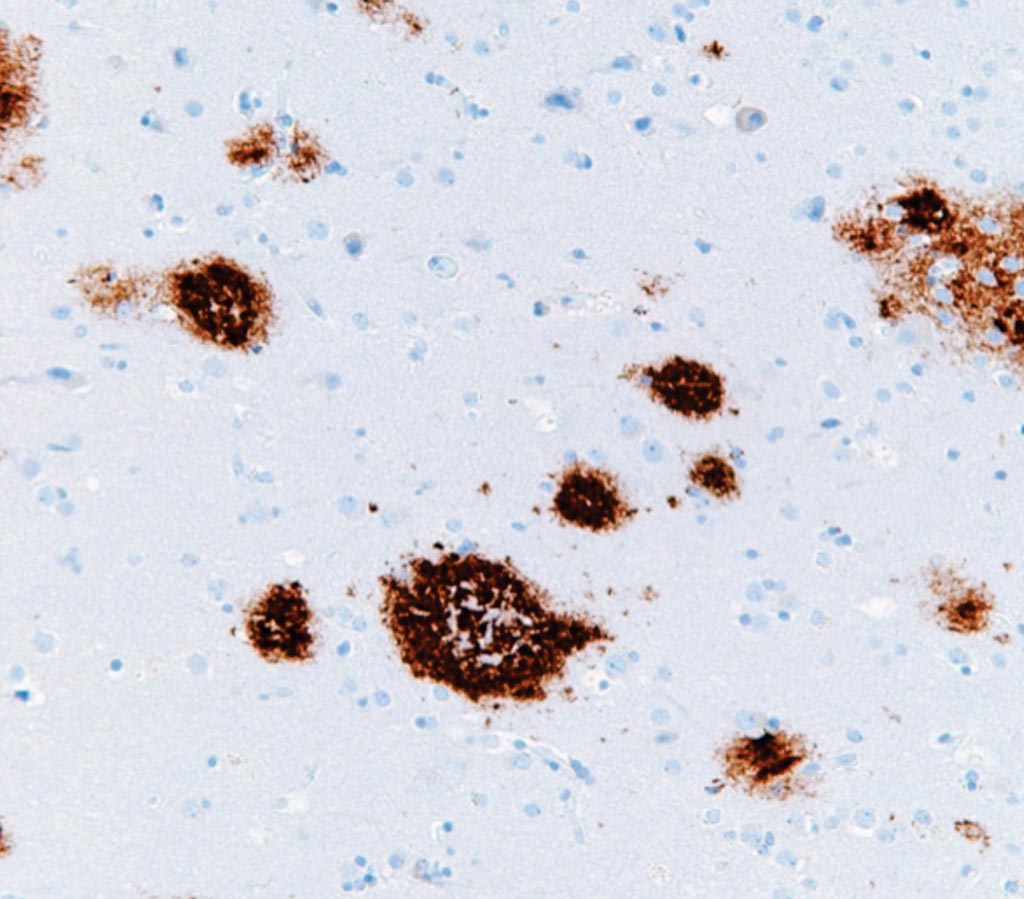 Image: A micrograph of cerebral amyloid angiopathy with senile plaques in the cerebral cortex consistent of amyloid beta, as may be seen in Alzheimer disease (Photo courtesy of Nephron).
