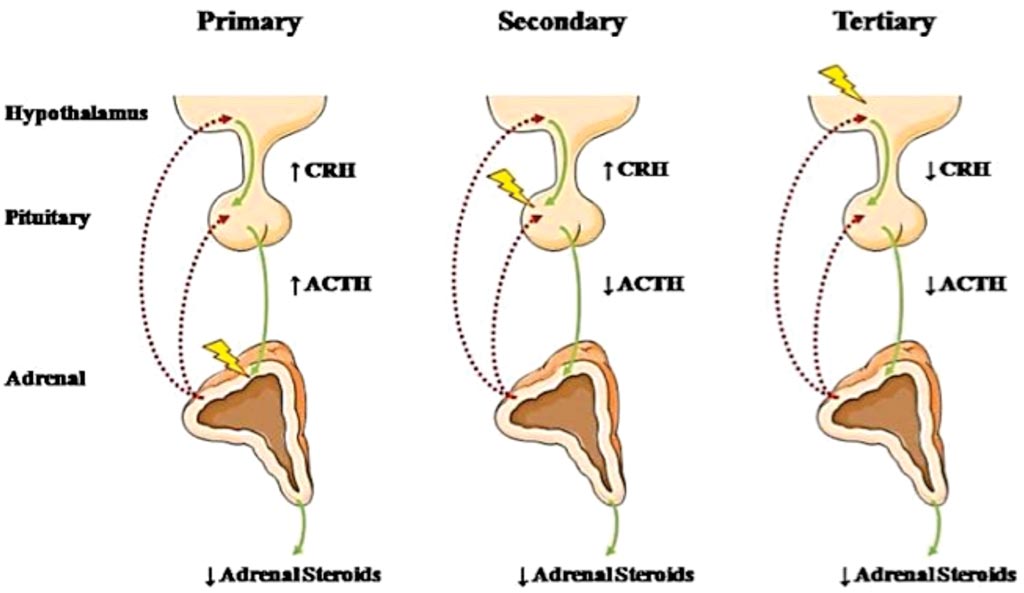 Image: A diagram of types of adrenal insufficiency; CRH: corticotropin-releasing hormone, ACTH: adrenocorticotropic hormone (Photo courtesy of US National Institute of Health).
