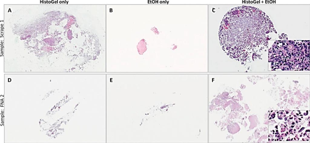 Image: A microscopic appearance of cell blocks prepared by the HistoGel + ethanol (EtOH) method versus HistoGel-only and the EtOH-only methods. The insets in C and F illustrate excellent cytomorphologic preservation with this method (Photo courtesy of Memorial Sloan Kettering Cancer Center).
