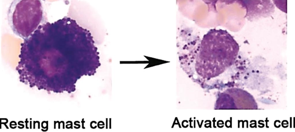 Image: Mast cells obtained from the human bone marrow; May-Grünwald/Giemsa stain of a resting human mast cell and a mast cell following activation-induced degranulation. Note the loss of granule staining (Photo courtesy of University Hospital of Bonn).