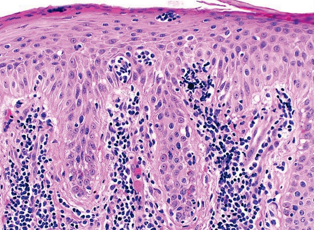 Image: A histopathology of classic Mycosis fungoides. This skin biopsy specimen demonstrates an atypical lymphocytic infiltrate going up into the epidermis (epidermotropism) in the absence of epidermal edema (spongiosis). The collection of atypical lymphocytes surrounding a Langerhans cell is a Pautrier microabcess, the hallmark of classic MF (Photo courtesy of the University of Pennsylvania).