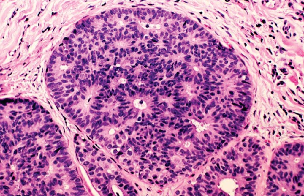 Image: A photomicrograph of breast cancer cells in purple surrounded by healthy tissue in pink (Photo courtesy of US National Institute of Health).