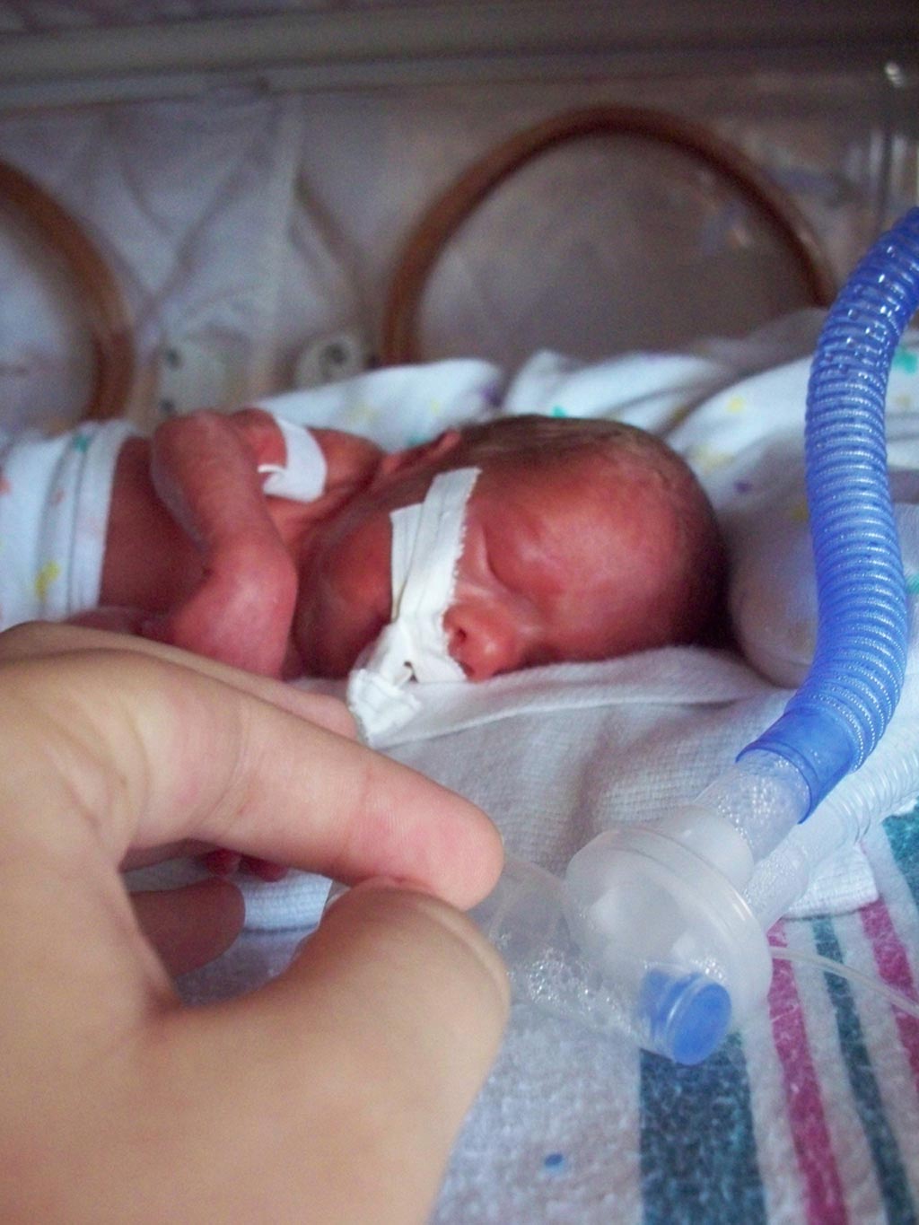 Image: An intubated baby that was born prematurely 26 weeks, six days gestation, weighing 990 grams. Photograph was taken approximately 24 hours after birth (Photo courtesy of Wikimedia Commons).