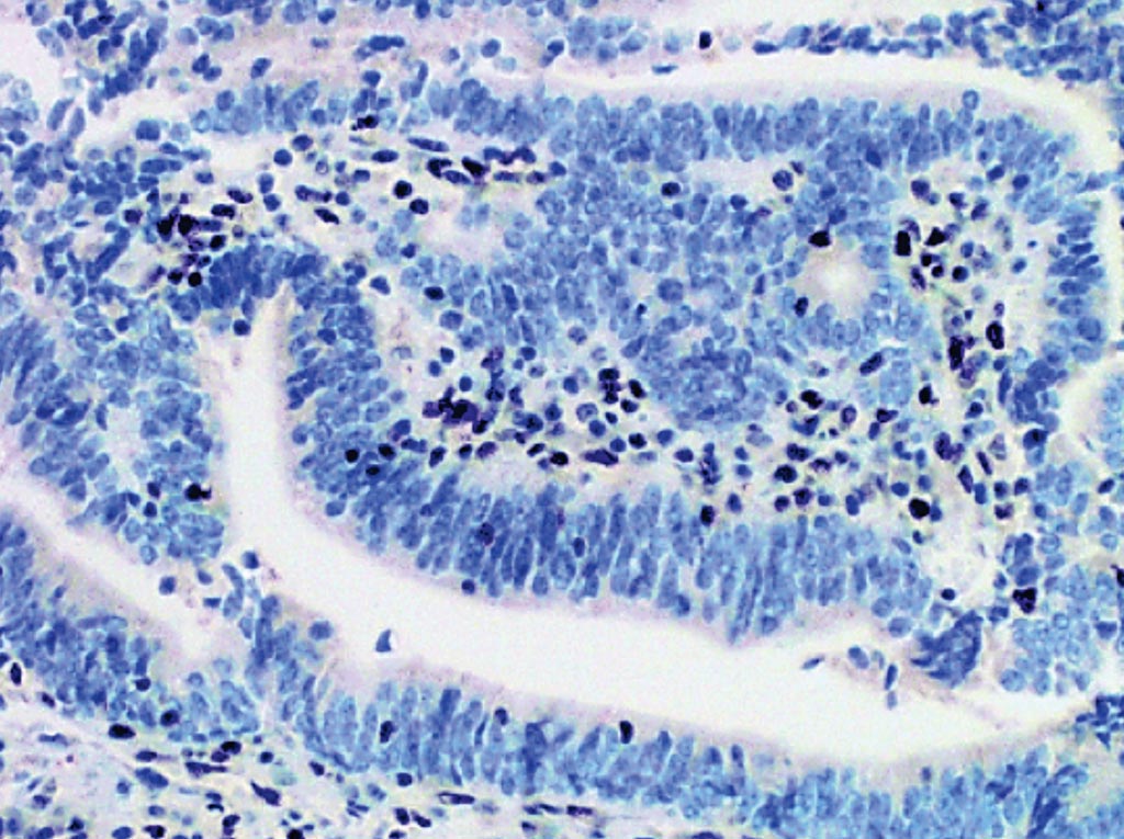 Image: An endometrial carcinoma showing loss of nuclear expression of MSH2. The lymphocytes and stromal cells should stain positive and represent an internal positive control (Photo courtesy of Memorial Sloan Kettering Cancer Center).