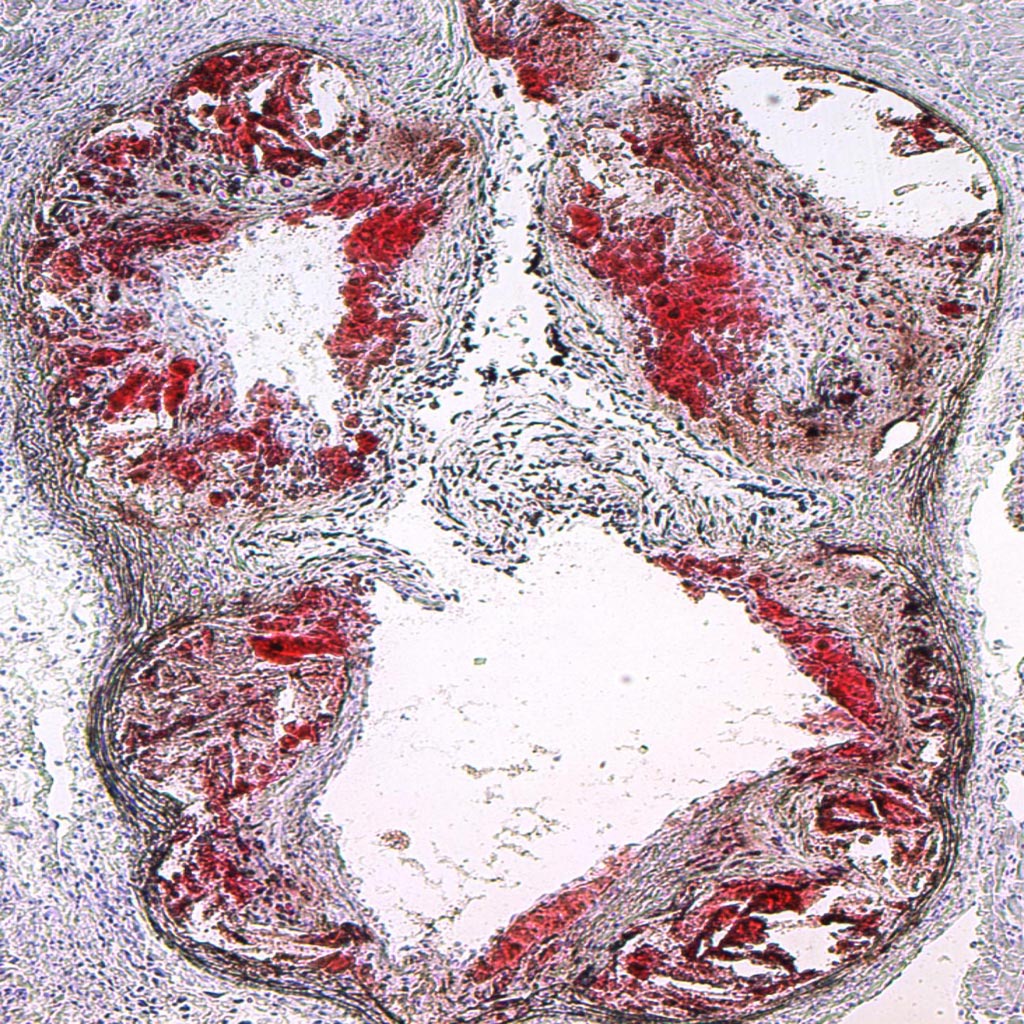 Image: Atherosclerotic lesions appear in red in this photomicrograph of a mouse aorta (Photo courtesy of Cedars-Sinai Medical Center).