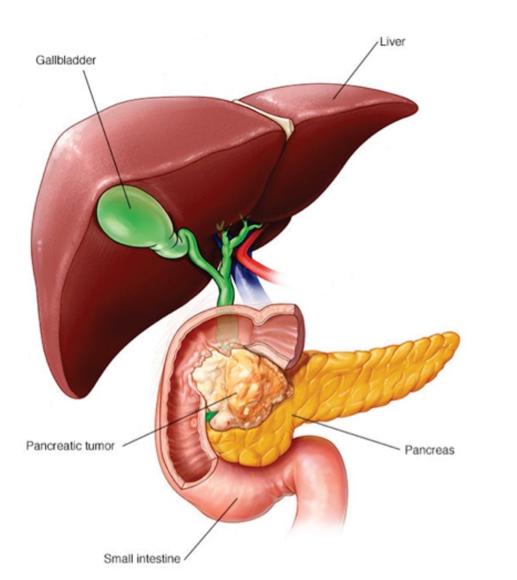 Image: Patients diagnosed with pancreatic cancer can develop elevated blood sugar levels up to three years before their cancer diagnosis (Photo courtesy of Mayo Clinic).