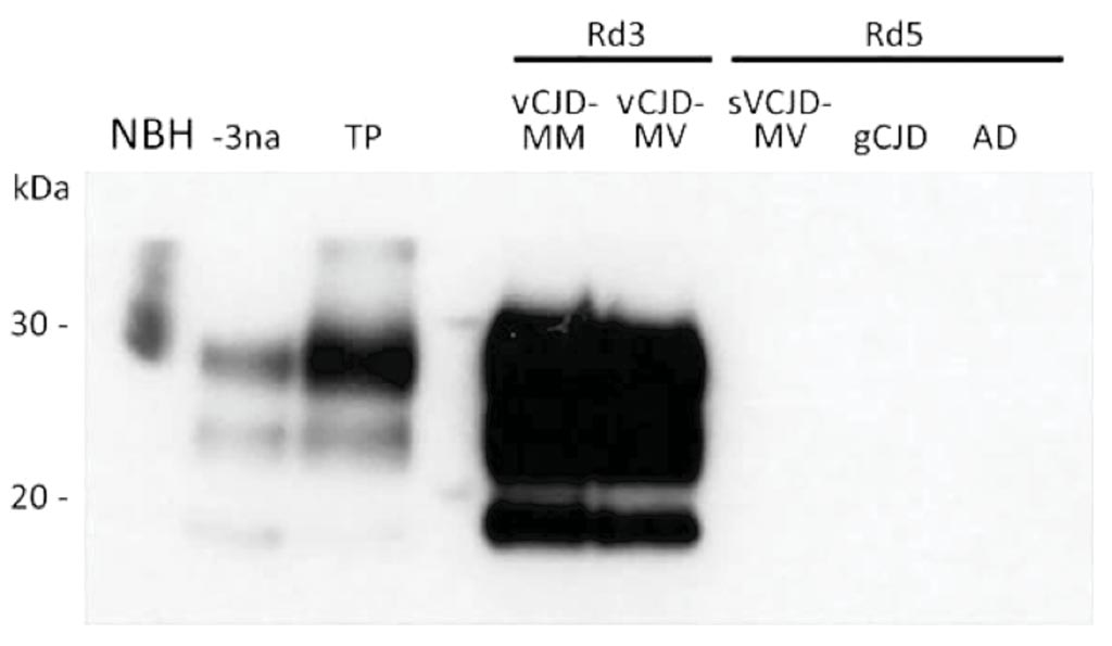 Image: A Western blot analysis of vCJD prions obtained after amplification by protein misfolding cyclic amplification (PMCA) of cerebrospinal fluid (CSF) from two patients with vCJD (MM and MV) and three control patients and a crude reference brain homogenate from a vCJD patient (Photo courtesy of Etablissement Français du Sang).