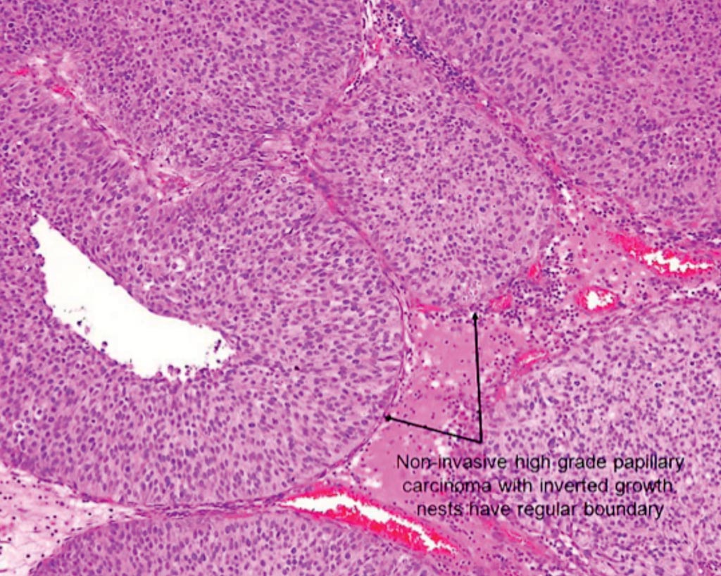 Image: A histopathology of papillary non–muscle-invasive bladder cancer (Photo courtesy of American Urological Association).