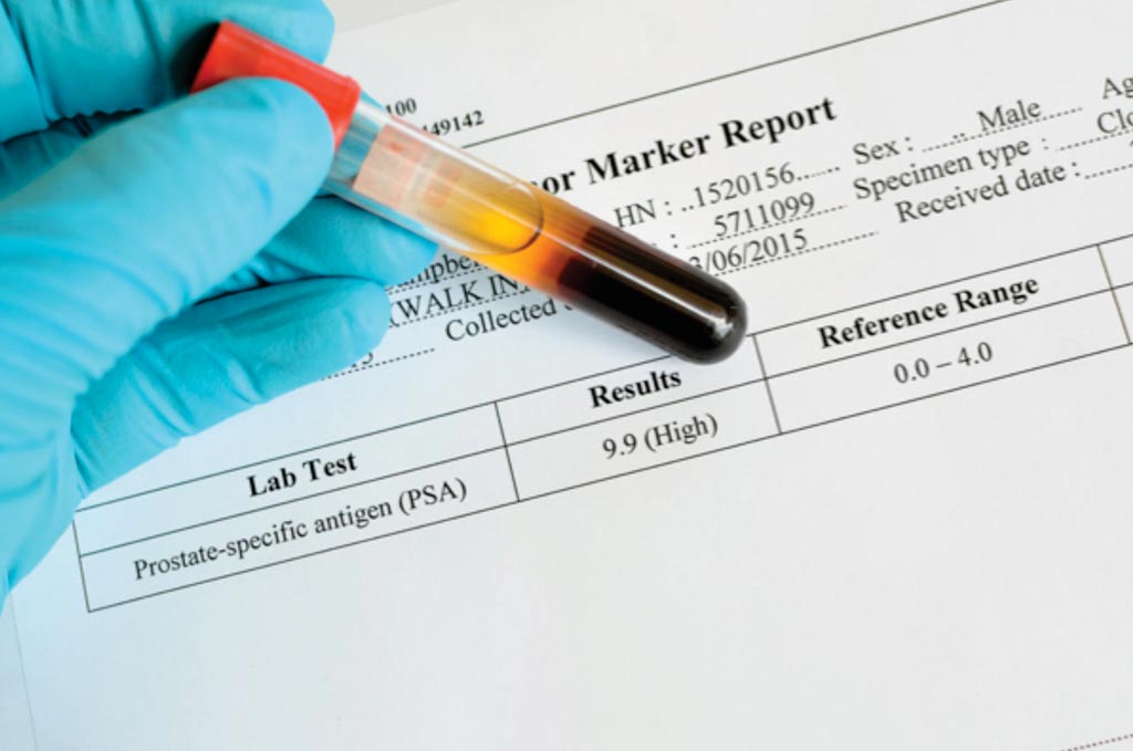 Image: Elevated levels of prostate specific antigen (PSA) in the blood can be an indicator of prostate cancer and lead to further diagnostic investigations (Photo courtesy of KeraNews).