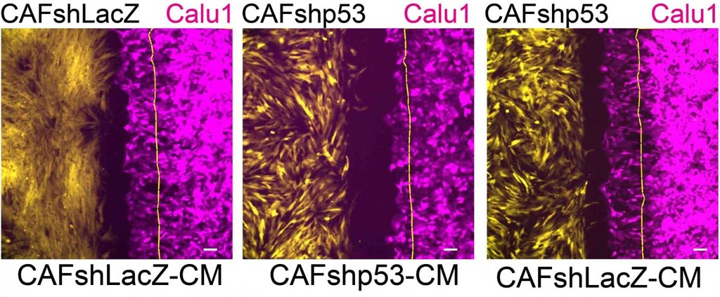 Image: The effects of p53 in cancer-associated fibroblasts on cancer cell migration: Cancer cells (magenta) migrate in the direction of cancer-associated fibroblasts (yellow) that express a non-mutated p53 gene (left); this migration slows down (center) when the p53 in the fibroblasts is silenced; when substances released by the cancer-associated fibroblasts are added to the laboratory dish, the migration is restored (right) (Photo courtesy of the Weizmann Institute of Science).