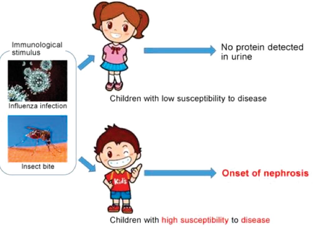 Image: A diagram of the hypothesis for the onset mechanism of childhood steroid-sensitive nephrotic syndrome (Photo courtesy of Kobe University).