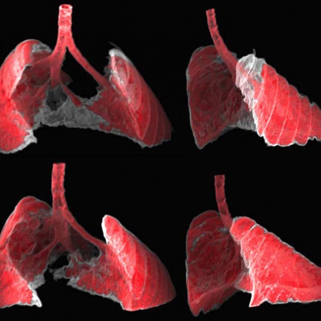 Image: The figure shows two views, frontal and lateral, of the image obtained by CT of the lungs of a mouse with fibrosis (grey areas) before and after receiving nano-therapy directed at senescent cells (Photo courtesy of Guillem Garaulet and Francisca Mulero, Institute for Research in Biomedicine).