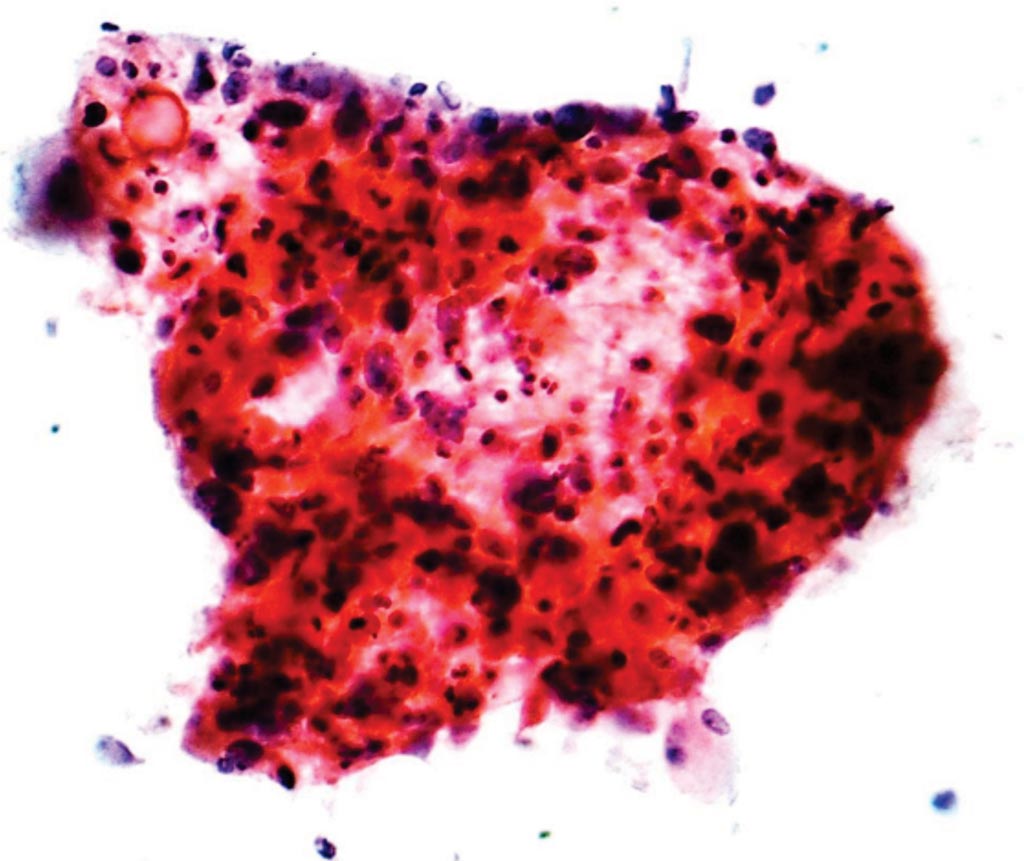 Image: A photomicrograph of squamous-cell carcinoma, a type of non-small-cell carcinoma of the lung, from a fine needle aspiration specimen (Photo courtesy of Nephron).