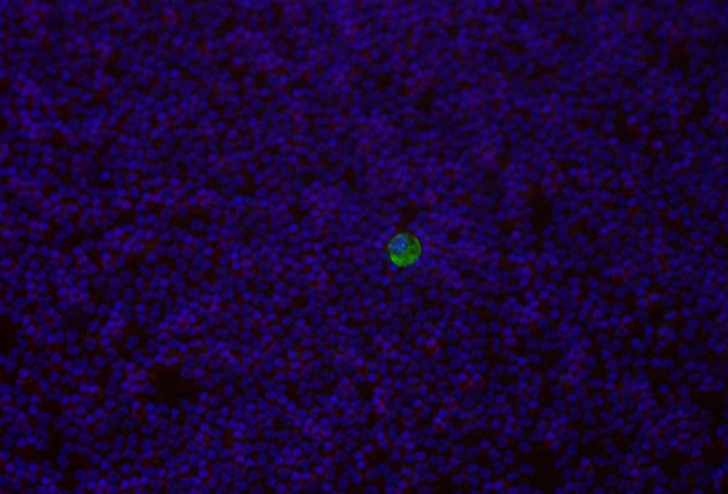 Image: A cancer cell colored with VAR2CSA (green) in a background of normal, white blood cells (red) (Photo courtesy of the University of Copenhagen Faculty of Health and Medical Sciences).