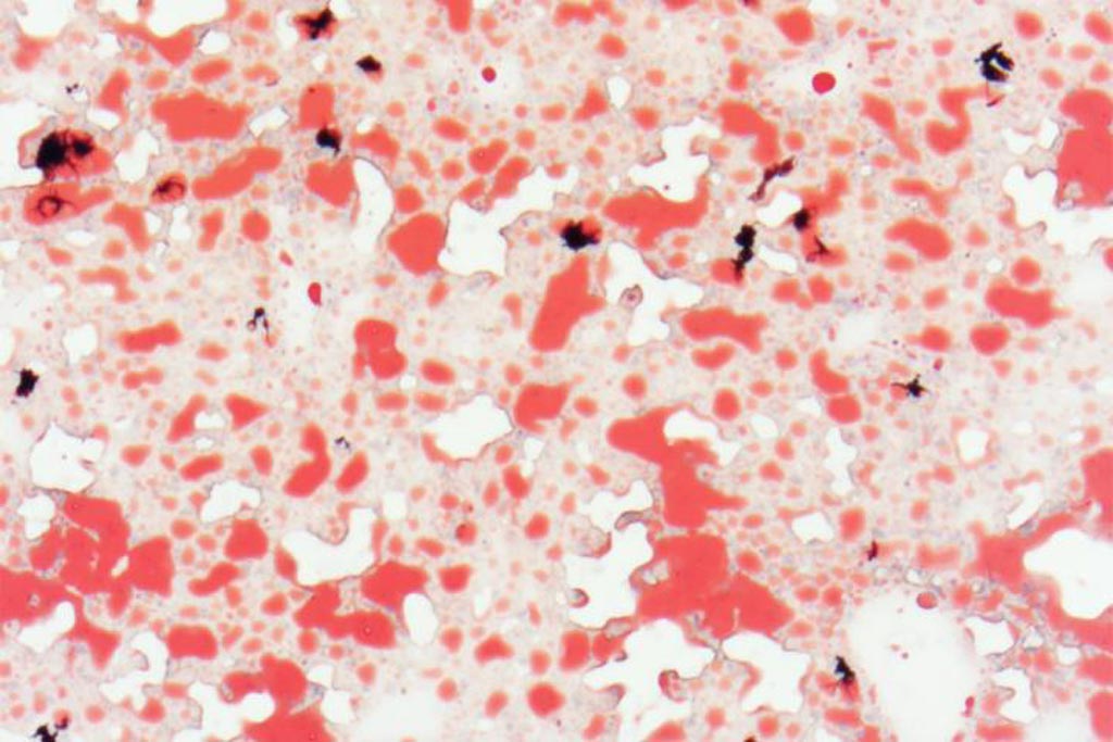 Image: Mice fed a diet high in trans fats and cholesterol for 12 weeks show fatty deposits in the liver (red staining) (Photo courtesy of Dr. Brian DeBosch, Washington University School of Medicine).