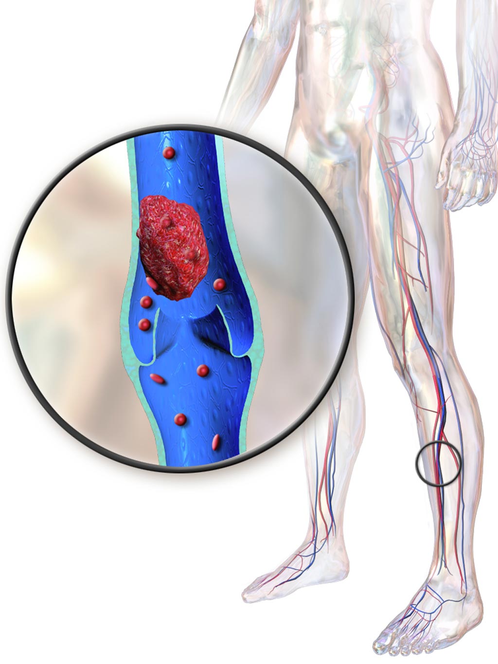 Image: An illustration depicting a deep vein thrombosis (Photo courtesy of Wikimedia Commons).