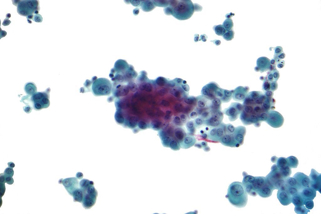 Image: A micrograph of a pleural fluid cytopathology specimen showing mesothelioma (Photo courtesy of Wikimedia Commons).
