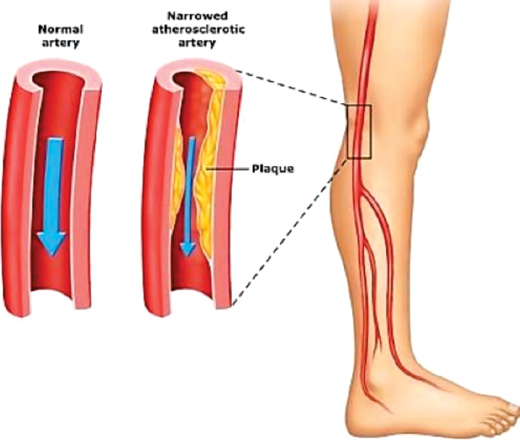 Image: A diagram of peripheral artery disease, blood vessels in the legs are the ones most often affected (Photo courtesy of Emed Pain Management Clinic).