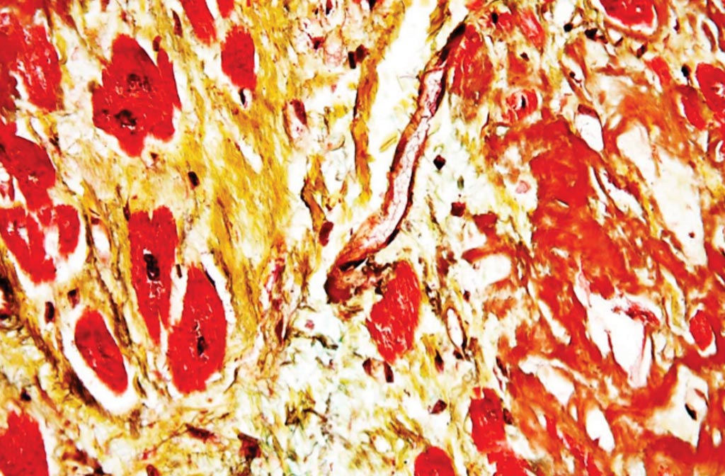 Image: High magnification micrograph of senile cardiac amyloidosis from an autopsy specimen (Photo courtesy of Nephron).