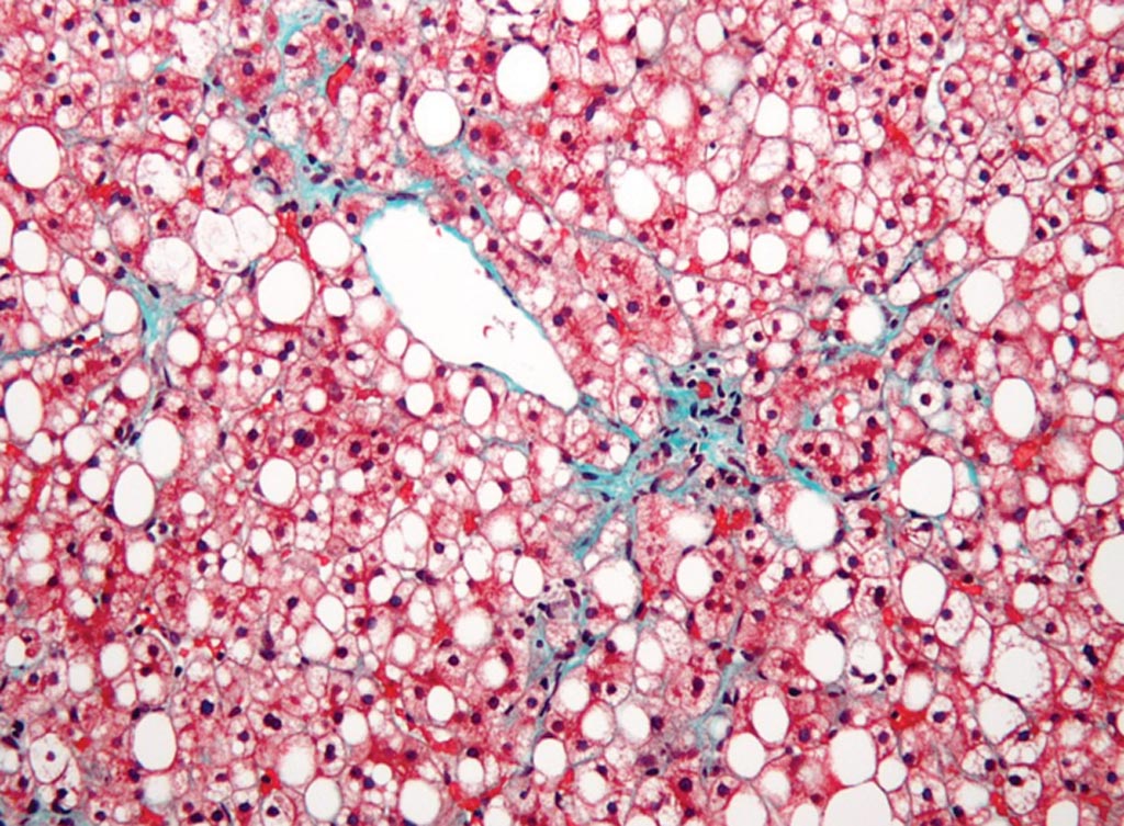 Image: A micrograph of non-alcoholic fatty liver disease, demonstrating marked steatosis (fatty liver appears white) (Photo courtesy of Wikimedia Commons).