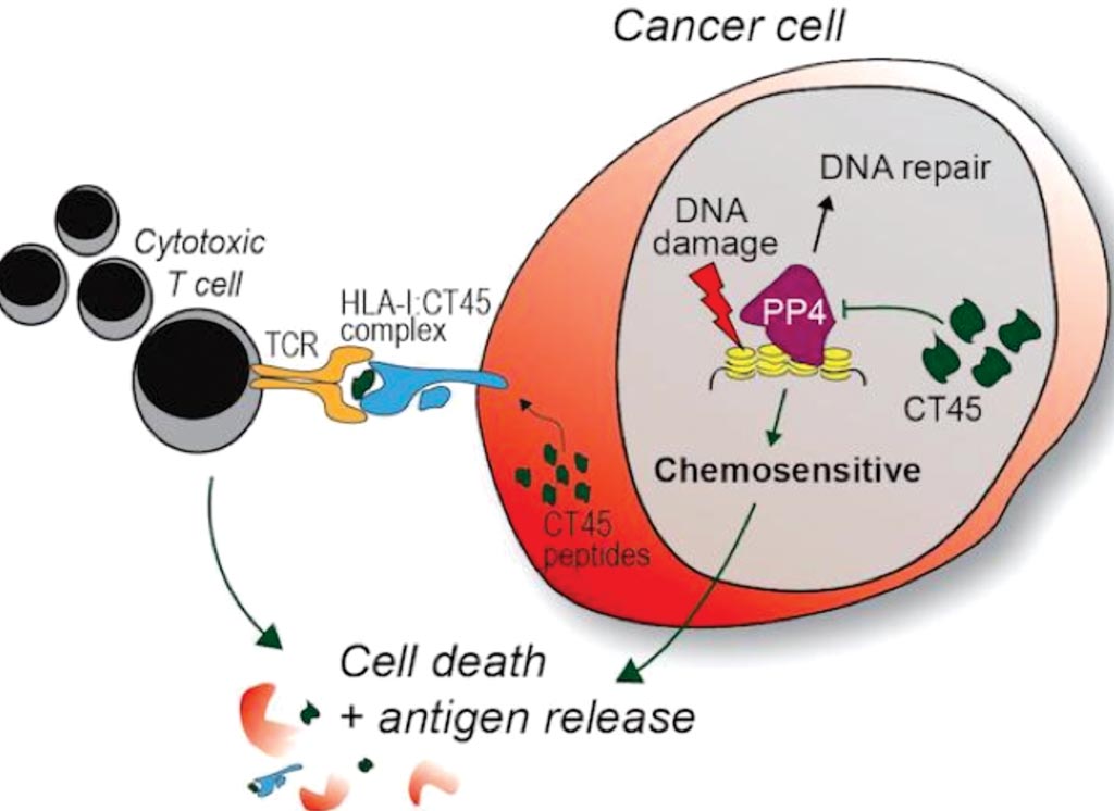 Image: CT45, a biomarker marker found in some ovarian cancer cells, is associated with extended disease-free survival for women with advanced ovarian cancer (Photo courtesy of University of Chicago Medical Center).