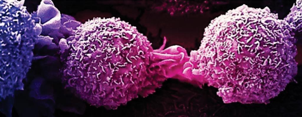 Image: A scanning electron micrograph of dividing breast cancer cells (Photo courtesy of National Cancer Institute).