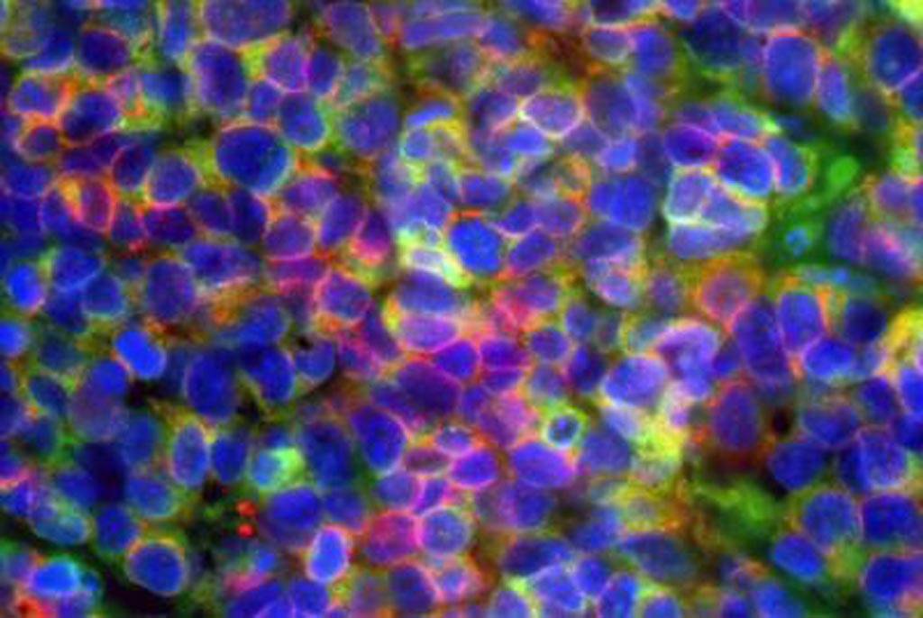 Image: A photomicrograph of small cell neuroendocrine prostate cancer: cancer cells are seen expressing diagnostic prostate cancer markers in green and red (blue color indicates the cell nucleus) (Photo courtesy of Jung Wook Park & Owen Witte, University of California, Los Angeles).