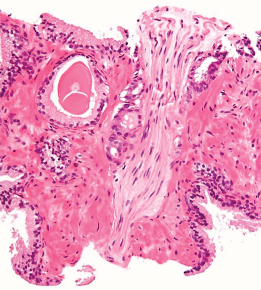 Image: A photomicrograph from a prostate biopsy of prostatic adenocarcinoma, conventional (acinar) type, the most common form of prostate cancer (Photo courtesy of Nephron).