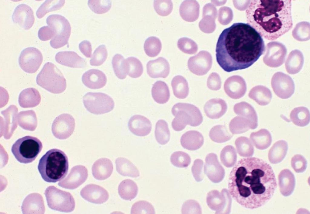 Image: A blood smear from a 68-year-old woman with a 13-year history of polycythemia vera and there are three red blood cell precursors present and slight to moderate anisopoikilocytosis (Photo courtesy of The Armed Forces Institute of Pathology).
