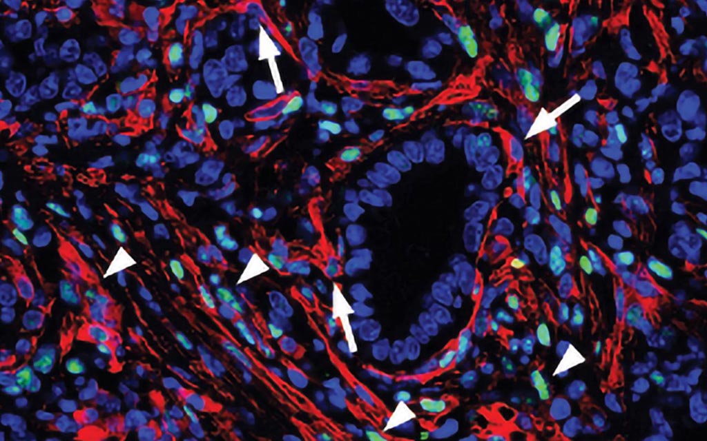 Image: In pancreatic cancers, the fibrous stroma is particularly abundant, making up nearly 90% of the tumor mass (Photo courtesy of Cold Spring Harbor Laboratory).