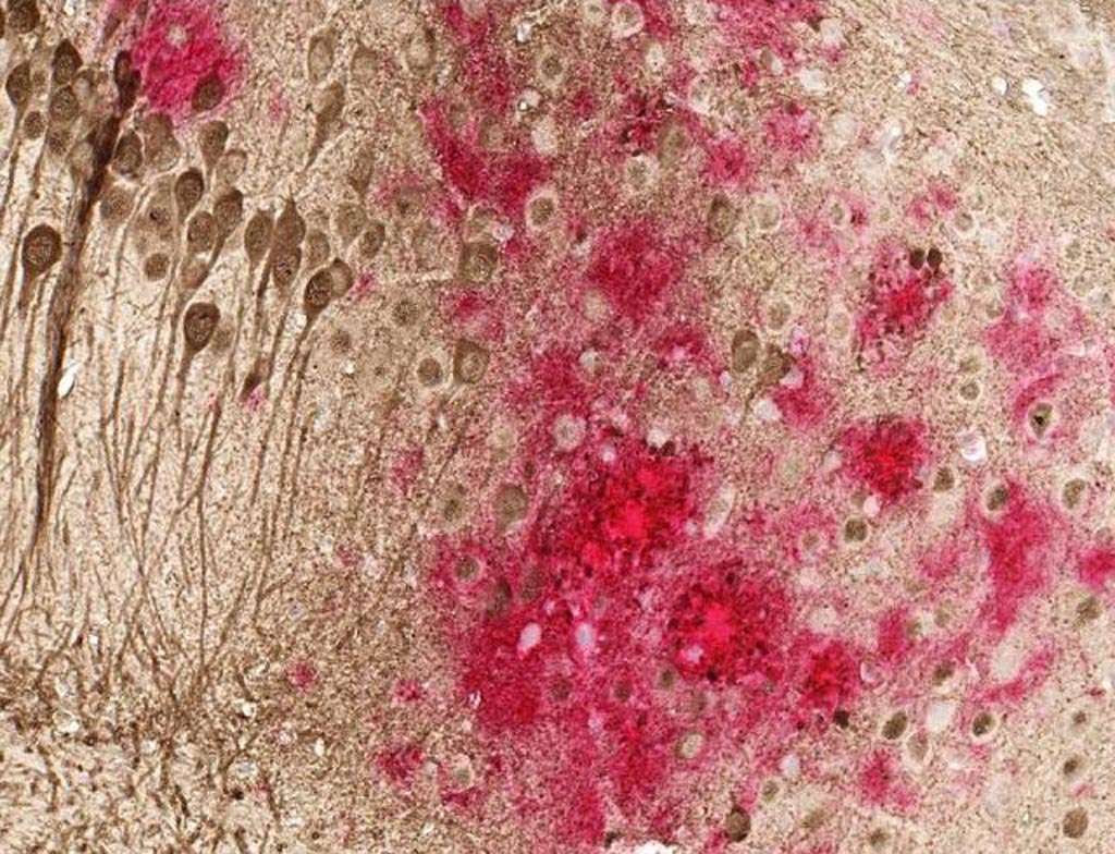 Image: Toxic amyloid plaques (red) and tau tangles (brown) form on the brain of a mouse modeled to have Alzheimer\'s disease. This study shows that a DNA vaccine reduces both amyloid and tau in the mouse AD model, with no adverse immune responses (Photo courtesy of the University of Texas Southwestern Medical Center).