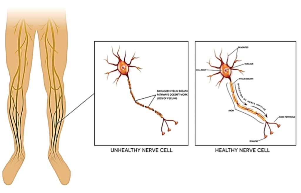 Image: Neuropathy is the damage of peripheral nerves; pain and loss of sensation in the extremities and can be caused by diabetes (Photo courtesy of Alnoor Ladhani).