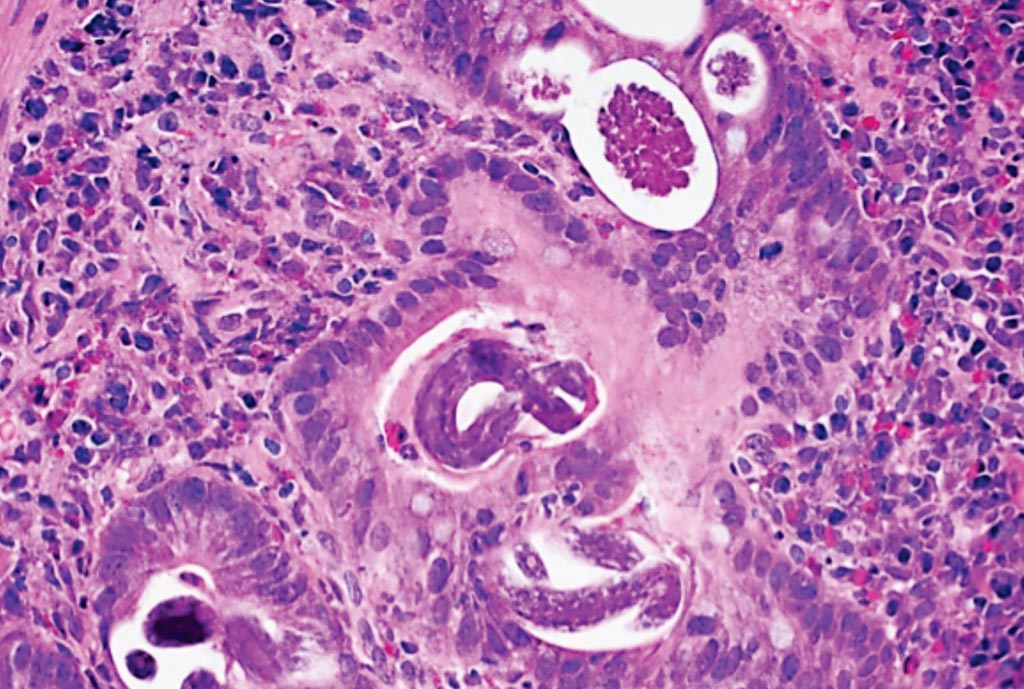 Image: A histopathology of Strongyloides stercoralis in the duodenum (Photo courtesy of Dr. Raul S. Gonzalez, MD).