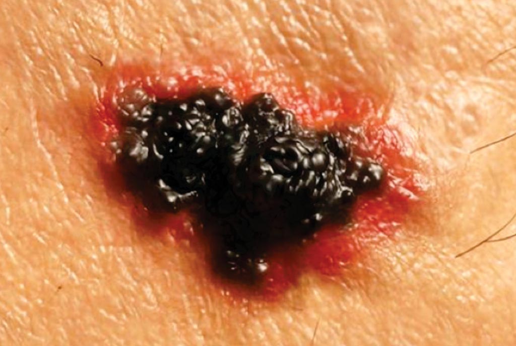 Image: A malignant melanoma of the skin (Photo courtesy of Juan Gaertner).