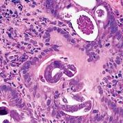 Imagen: Una histopatología de Strongyloides stercoralis en el duodeno (Fotografía cortesía del Dr. Raul S. González, MD). Imagen: Una histopatología de Strongyloides stercoralis en el duodeno (Fotografía cortesía del Dr. Raul S. González, MD).