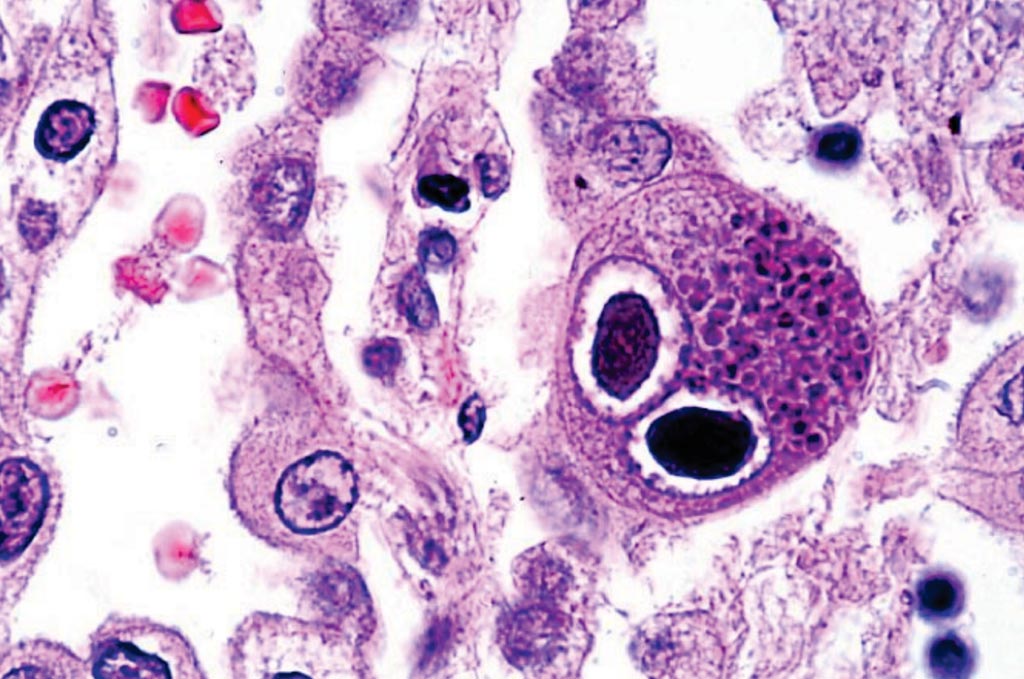 Image: A histopathology of cytomegalovirus infection in the lung showing typical owl-eye inclusions; FDA clears new CMV test for newborns (Photo courtesy of Danny Wiedbrauk, PhD).