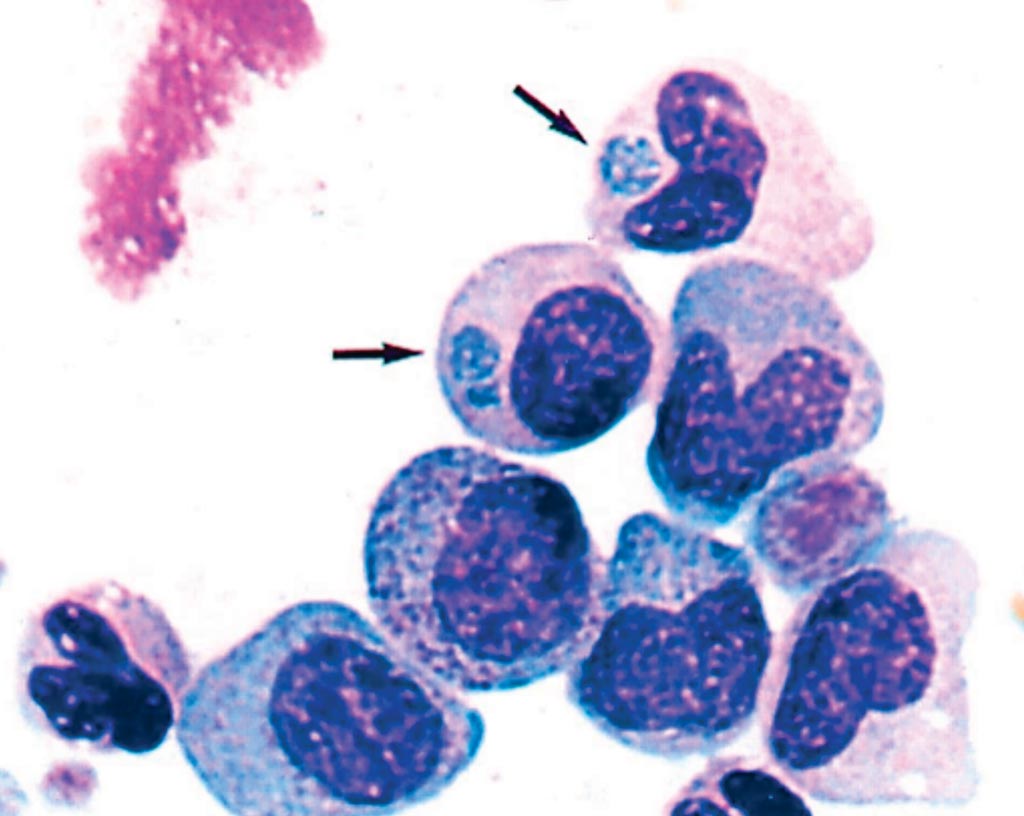 Image: Photomicrograph of a buffy coat smear of the patient’s blood collected on the third hospital day. Anaplasma phagocytophilum inclusions are seen in the cytoplasm of two different granulocyte stages (a metamyelocyte and a myelocyte). Arrows indicate morulae (Photo courtesy of Westchester Medical Center).