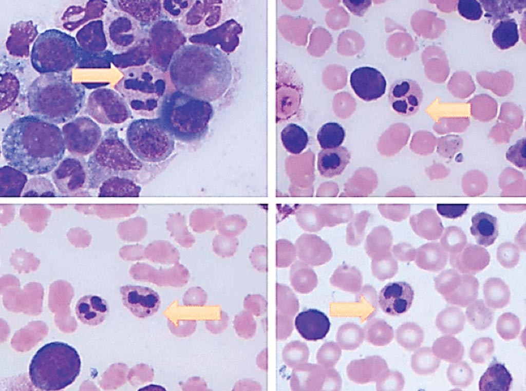 Image: Howell-Jolly body–like inclusion within neutrophil (arrow). It appears as a completely detached and densely basophilic inclusion in the cytoplasm of neutrophil. Photos were taken from different cases (Photo courtesy of University of Texas Health Science Center at Houston).