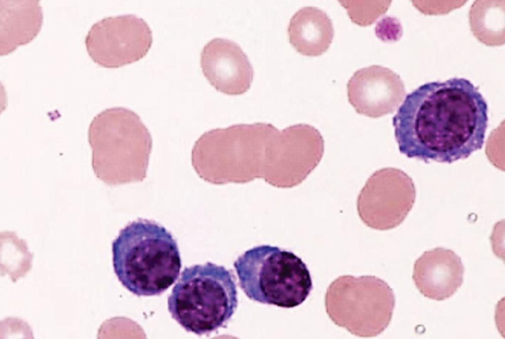 Image: A peripheral blood film from a patient with plasma cell leukemia showing four plasma cells and rouleaux formation of erythrocytes (Photo courtesy of the Tsuyako Saito).