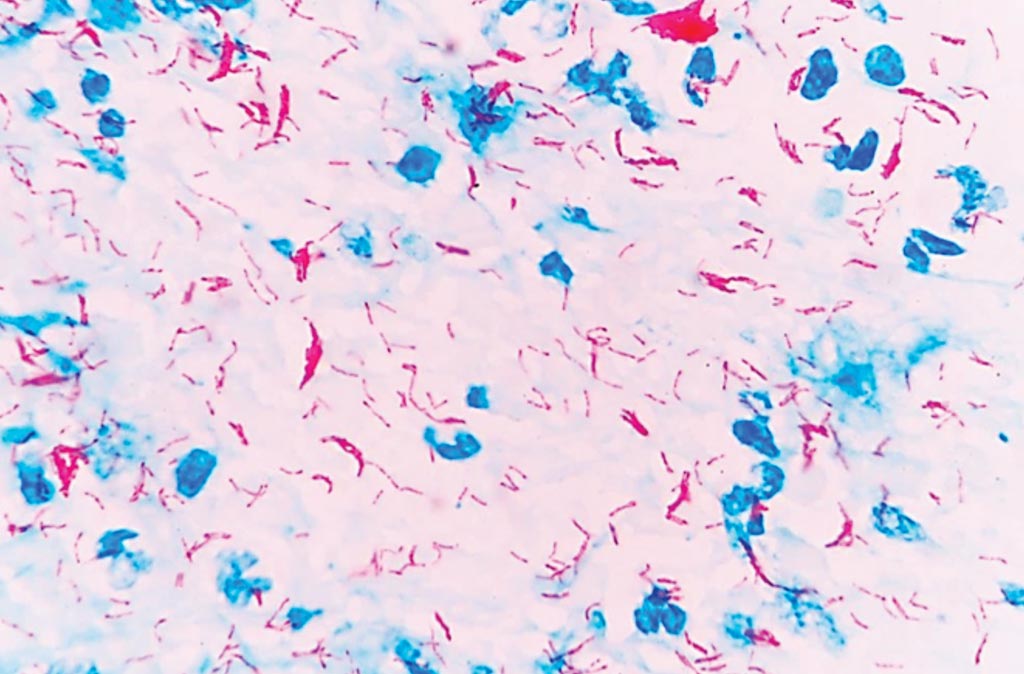 Image: Photomicrograph of Acid-fast Ziehl-Neelsen Staining of Mycobacterium tuberculosis in a sputum smear (Photo courtesy of Rockefeller University).
