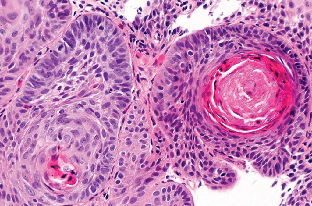 Image: A histopathology of squamous cell carcinoma of the esophagus (Photo courtesy of Nephron).